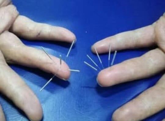 Combo Acupuntura Sistêmica e Moxabustão em Cidade Monções